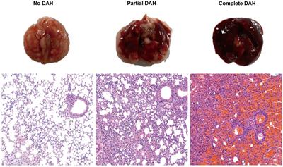 Quantitative proteomic analysis and replacement therapy identifies haptoglobin as a therapeutic target in a murine model of SLE-associated diffuse alveolar hemorrhage